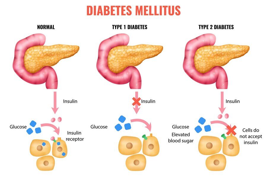 Gut Health and Insulin Resistance 